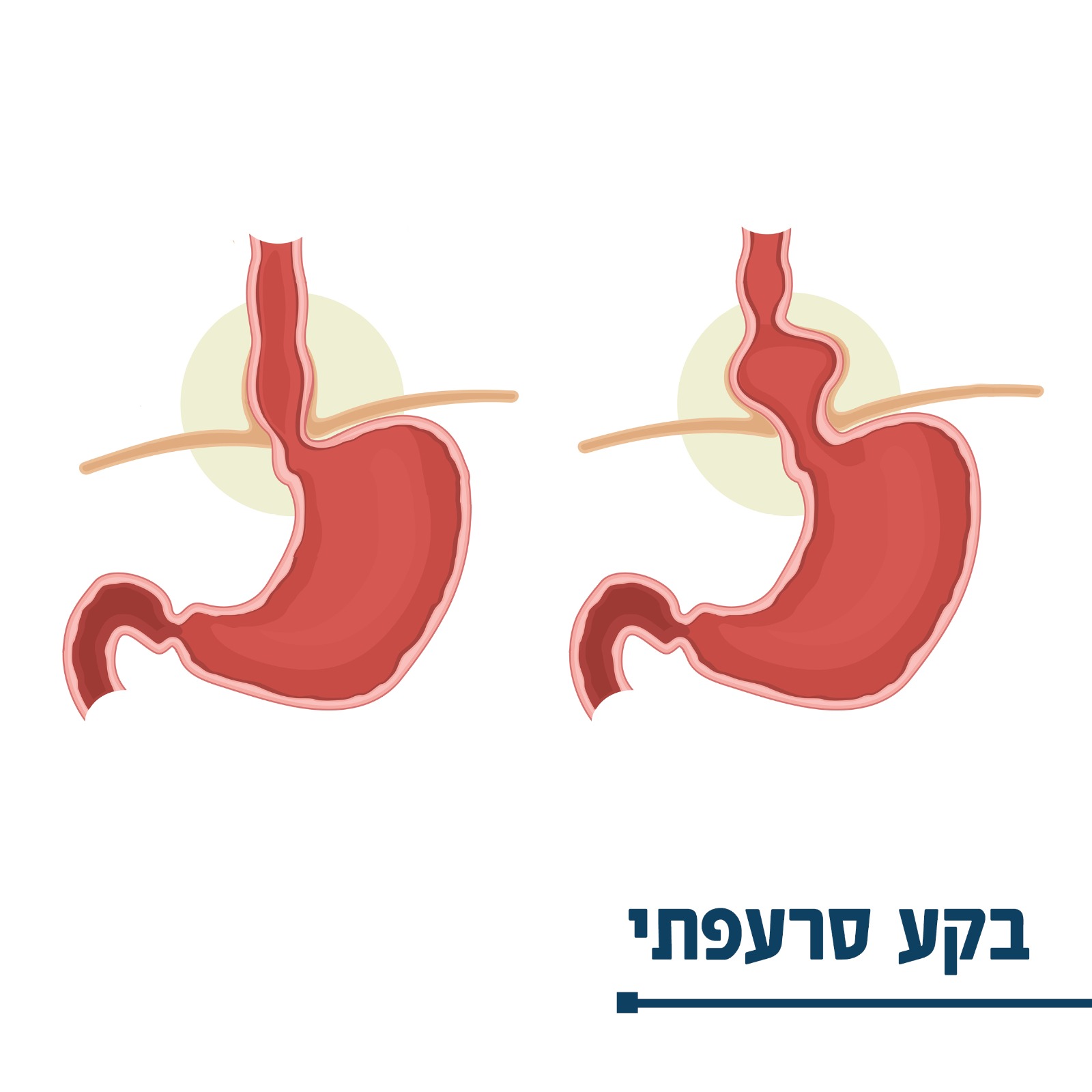 ניתוח לתיקון בקע בסרעפתי - דר' דביר פרויליך