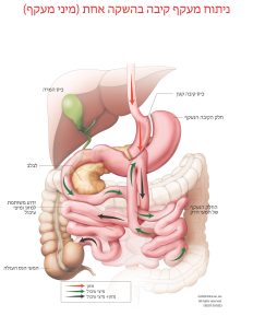 ניתוח מעקף קיבה