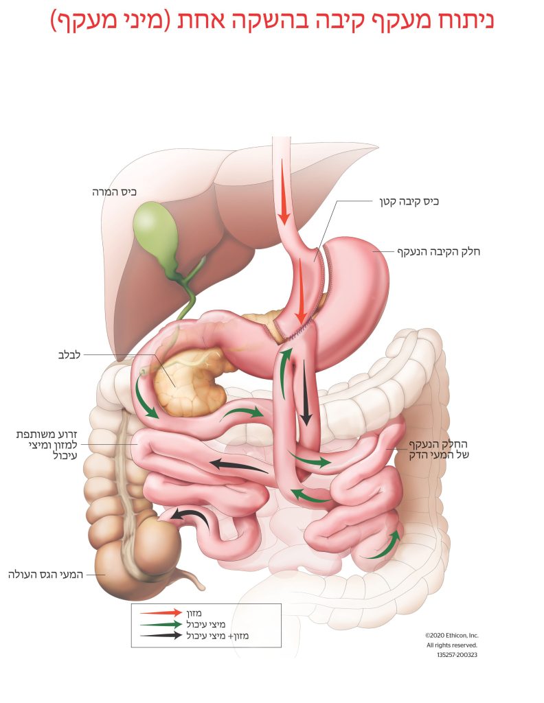 ניתוח מעקף קיבה