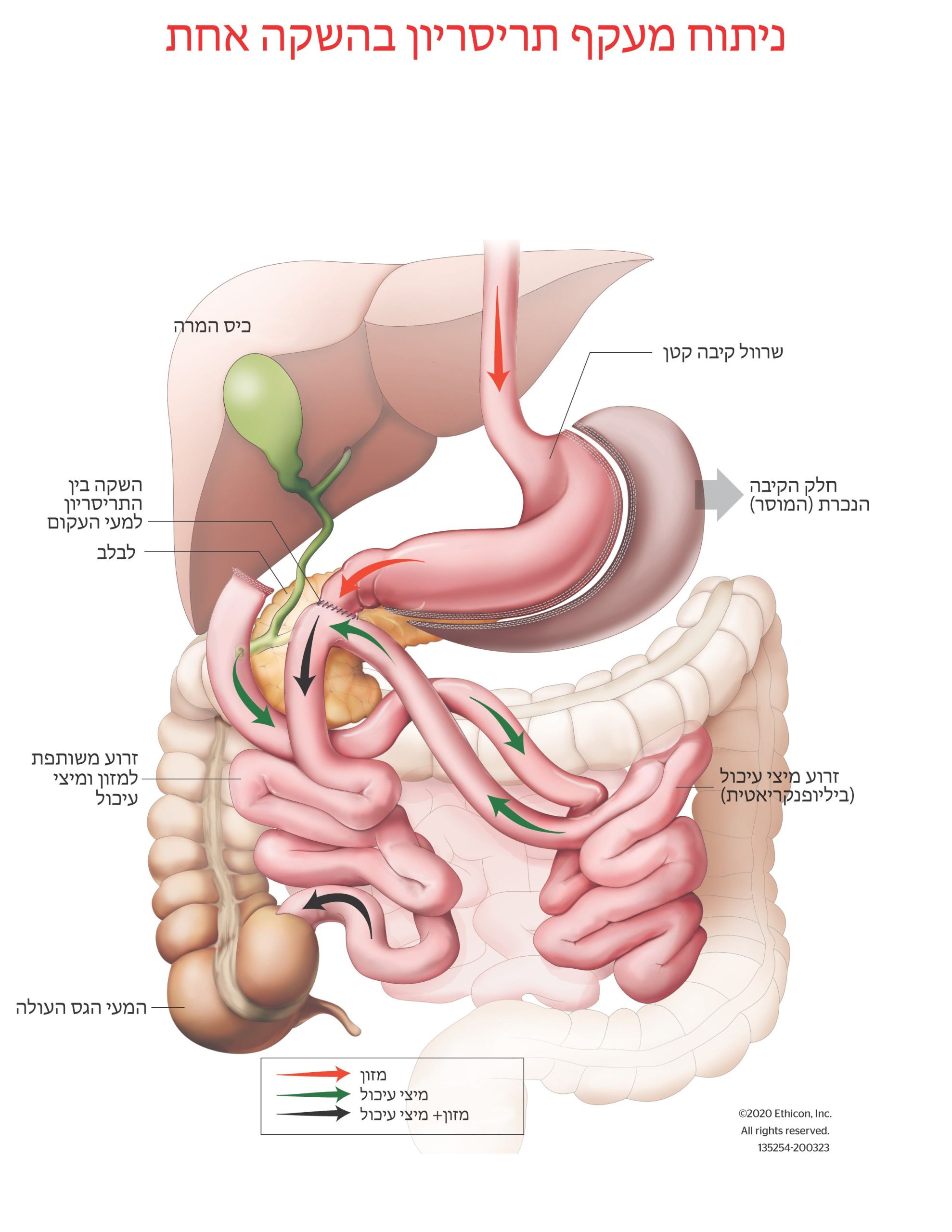 ניתוח מעקף תריסריון
