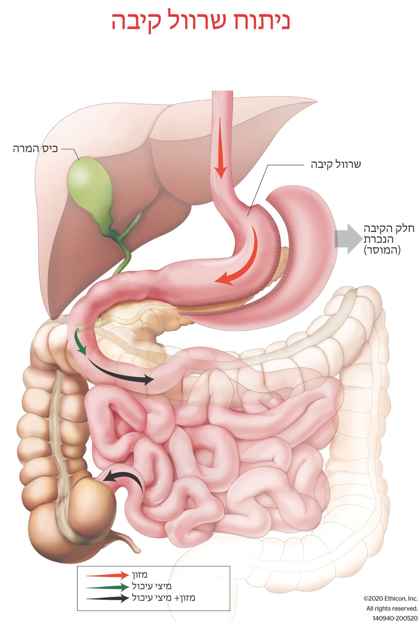 ניתוח שרוול קיבה